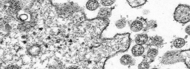 Transmission electron microscopic image of an isolate from the first U.S. case of COVID-19, formerly known as 2019-nCoV. The spherical extracellular viral particles contain cross-sections through the viral genome, seen as black dots.